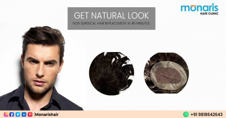 Hair Replacement in Delhi
