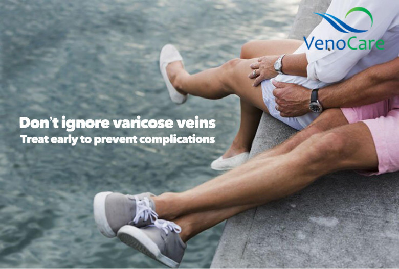 varicose veins treatments