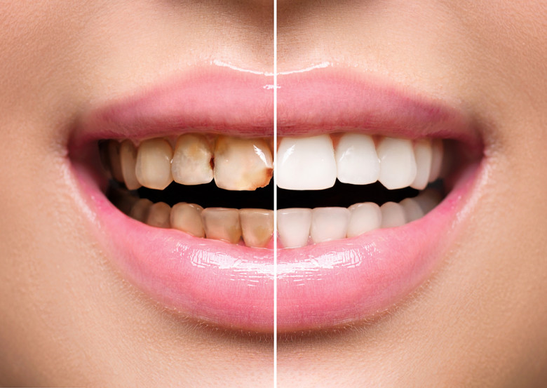 Teeth Cleaning &Teeth Whitening - Eternal Smile