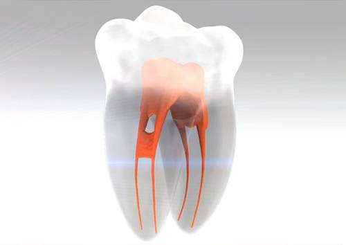 Best Root Canal Treatment - Eternal Smile.