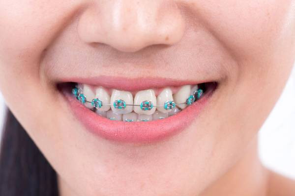 Best Braces for Teeth - Eternal Smile.