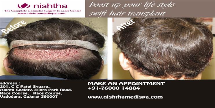 Nishtha Medi Spa easy and cost effective Cosmetic Surgery of lips.