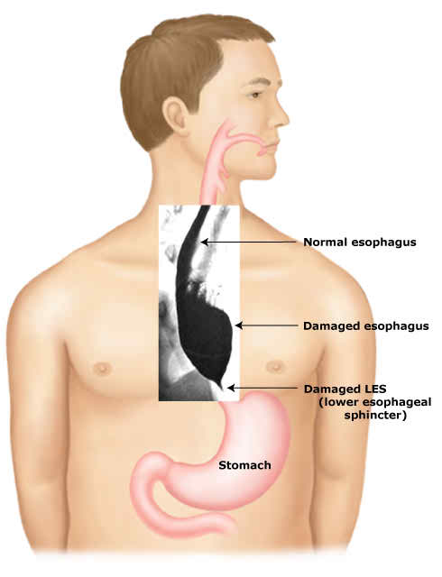 Achalasia Causes, Symptoms, Diagnosis, Prevention And Treatment