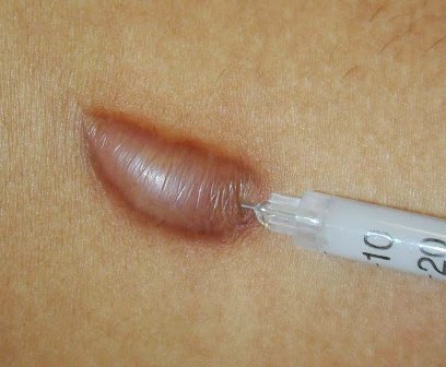 info penyakit keloid dan pengobatannya - Gaya Hidup Sehat
