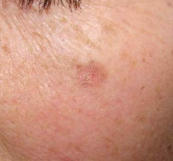 Actinic Keratosis Symptoms, Diagnosis, Prognosis And Treatment