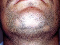 Alopecia Causes, Symptoms, Diagnosis And Treatment