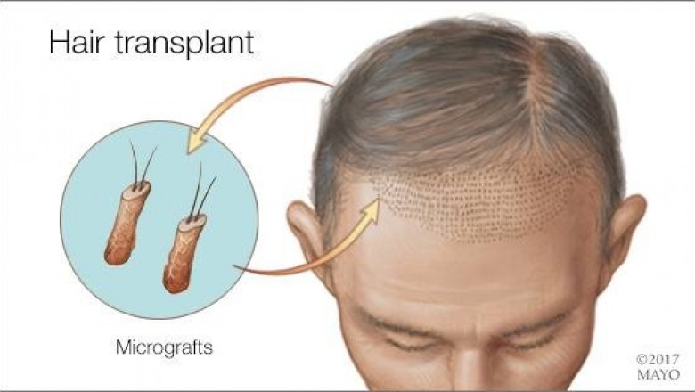 Seven Hair Transplant Myths
