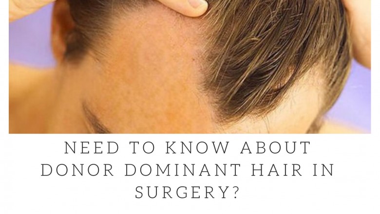 Need To Know About Donor Dominant Hair in Surgery?