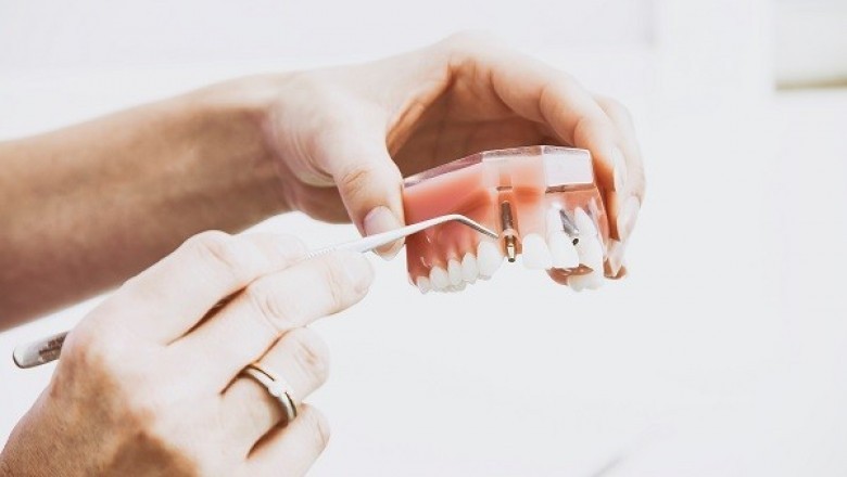 Dental Veneers and their Uses