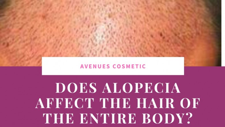 Does Alopecia Affect The Hair Of The Entire Body?