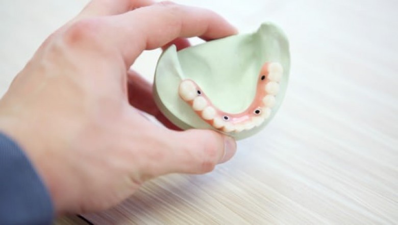 Top Reasons to Look into Dental Veneers