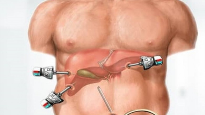Things to Know About Keyhole (Laparoscopic) Sleeve Gastrectomy