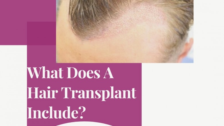 Have You Been Wondering Which Is The Right Hair Transplant For You?