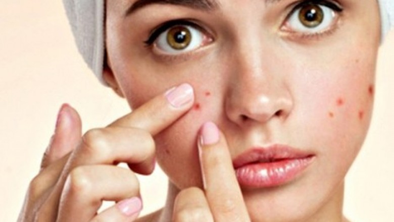 Psoriasis specialist in Delhi