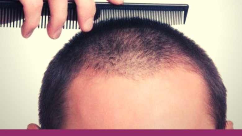 3 Reasons Why You Should Go For Hair Transplantation
