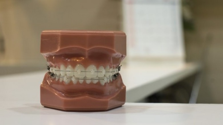 What Food Could Negatively Affect Your Dental Veneer?