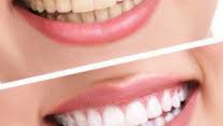 Invisible Braces – Confident Dental Practice