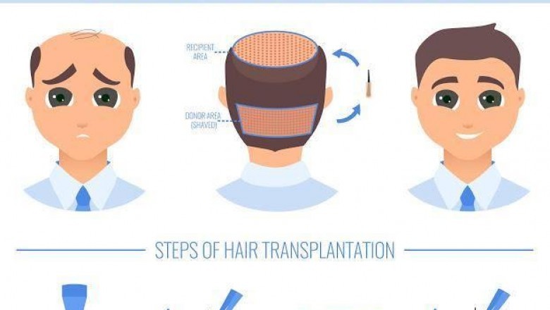 Technique Vs Cost Perspective of Choosing The Hair Transplant Procedure