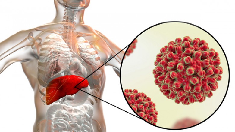 Hepatitis A: Symptoms, Causes and Treatment