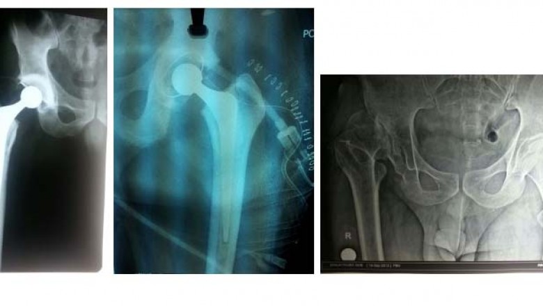 Your Best Partial Knee Replacement Surgery in Thane : Hip Replacement Surgeon In Thane