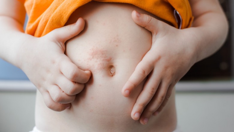 All You Need to Know about the Varicella Zoster Virus