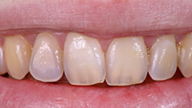 Tooth Erosion | Urgent Dental Care New York