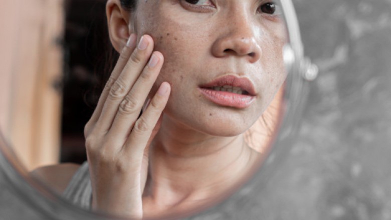 Remove dark spots on skin