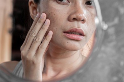 Remove dark spots on skin