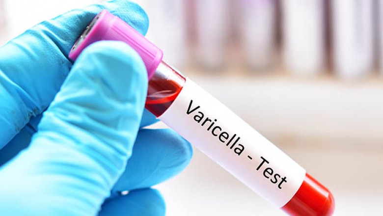 Know about Varicella Test