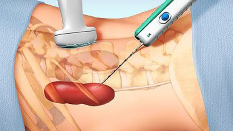 Things to Know About a Biopsy Test