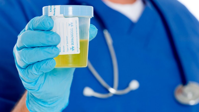 What You Need To Know About Urine Sugar Test
