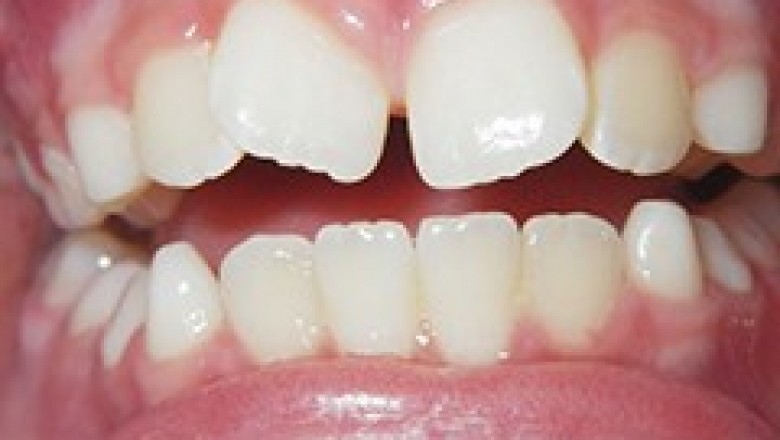 Overcrowding Teeth | Urgent Dental Care Chandler 85224