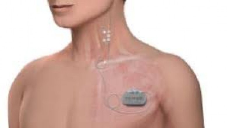Global Vagus Nerve Stimulators Market Trends, Size, Forecast - 2019-2025