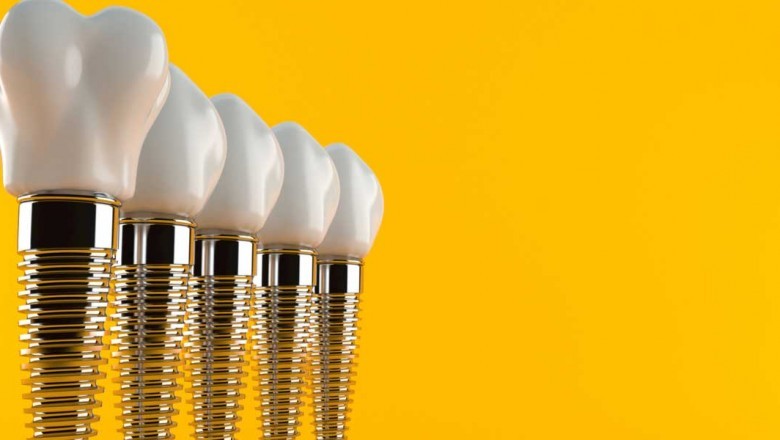 An Overview of the Dental Implant Procedure
