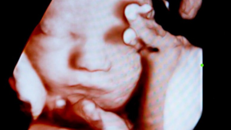 Dental X-Rays Are Safe During Pregnancy!