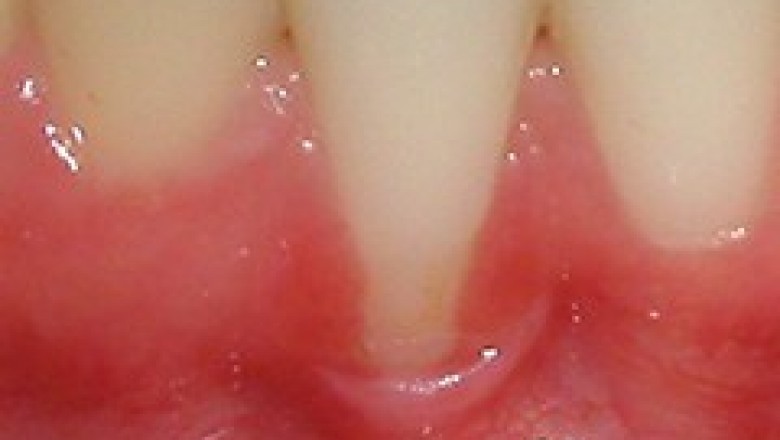 Root Exposure | Emergency Dental Services in San Diego