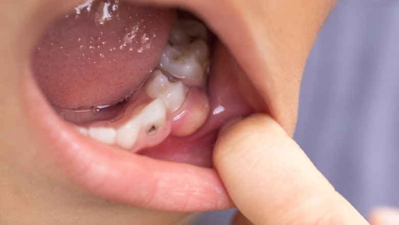 The Causes of Tooth Decay