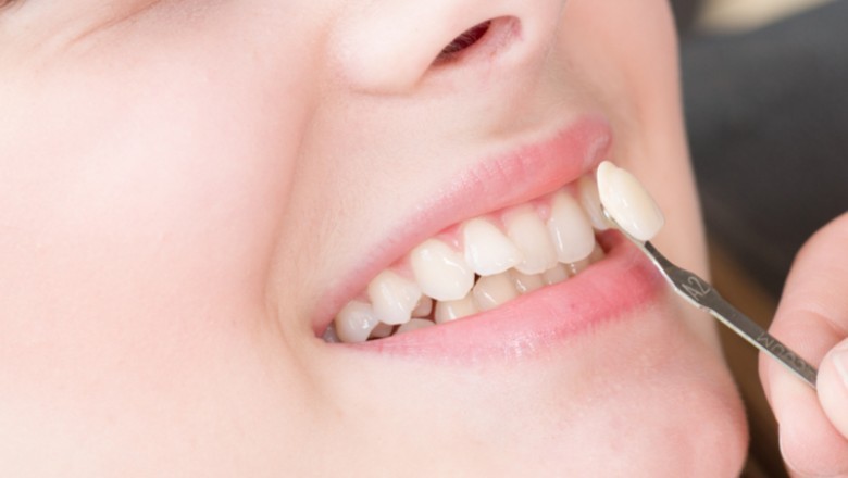 Veneers or Crowns: Which is Right for Me