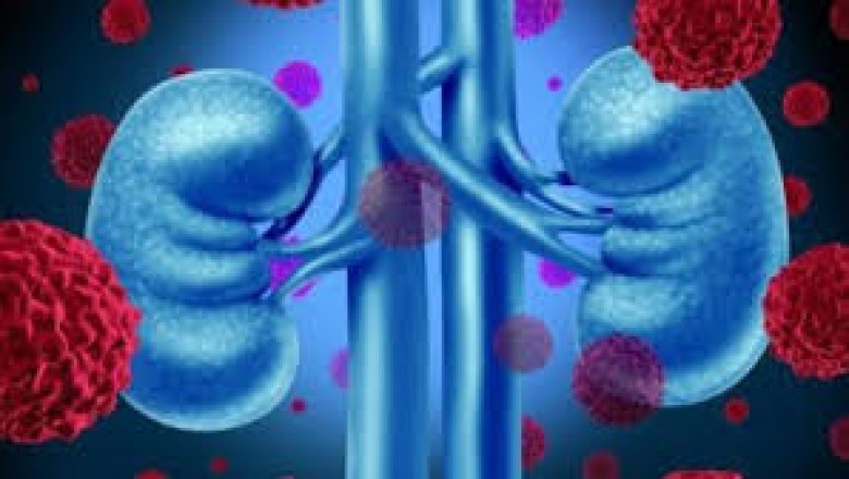 Global Kidney Cancer Market Trends, Size, Forecast - 2018-2023