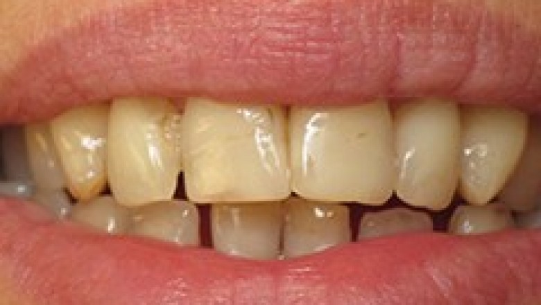 Tooth Stains | Dental Emergency in Philadelphia, 19151