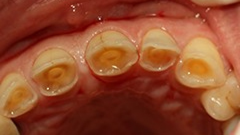Tooth Abrasion | Dental Emergency in Upper Darby
