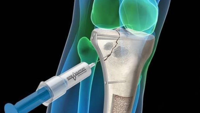 Bone Grafts and Substitutes Market Global Demand, Latest Technology and Outlook 2020 to 2030