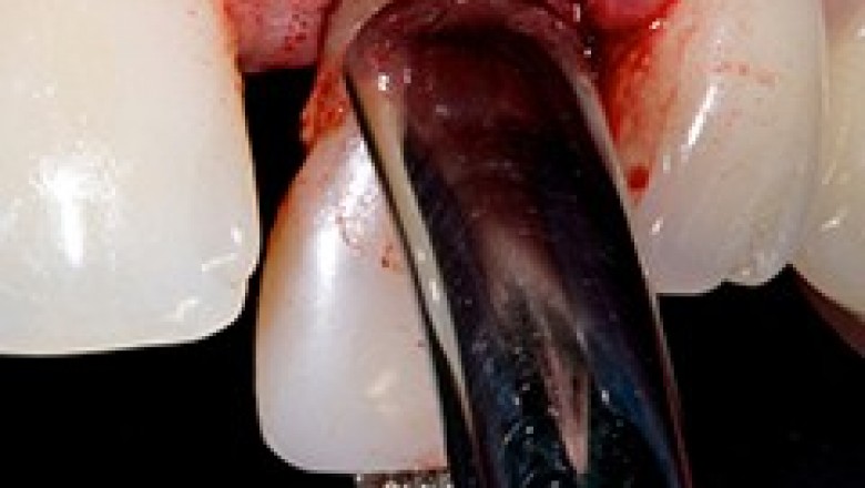 Tooth Extraction | Dental Emergency in Atlanta, 30305