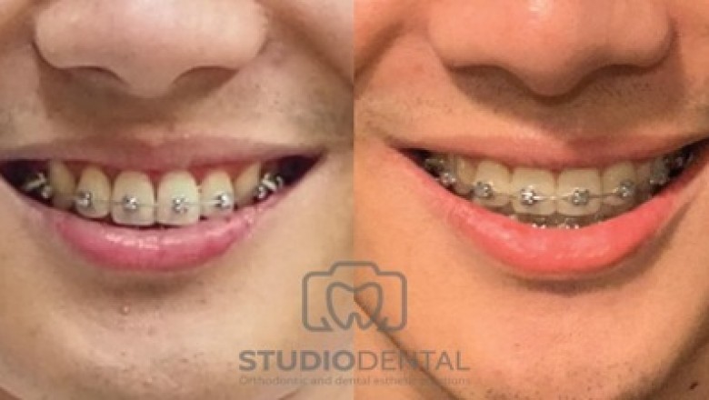 Orthodontics - How Can A Smile Be Improved With Orthodontics?