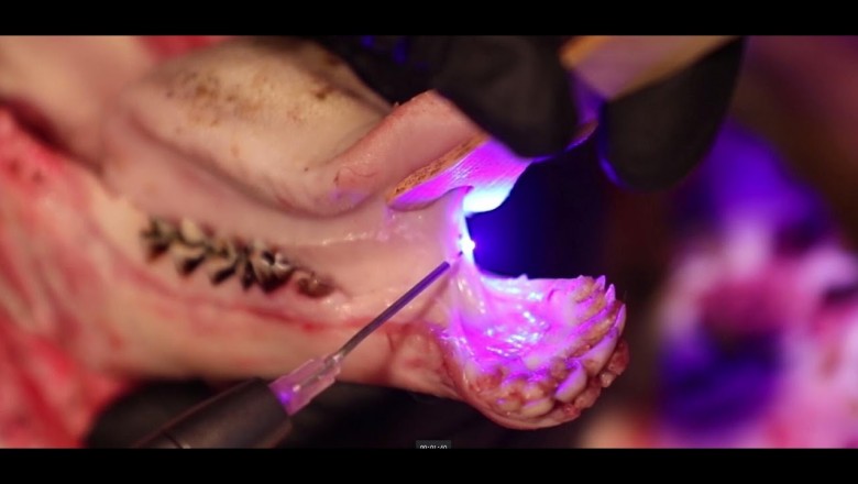 Tongue Tie Procedure/ Frenectomy Using S1 PIOON 450 Wavelength Laser