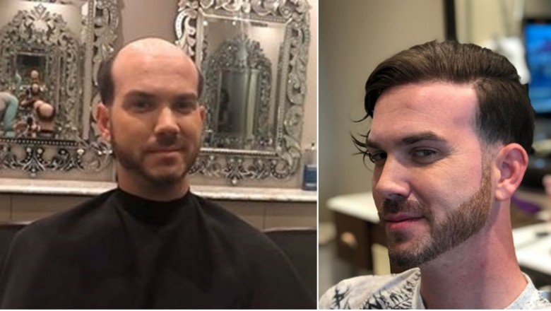 Difference between hair transplant and non-surgical hair replacement