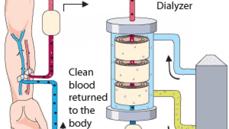Hemodialysis Market by Global Size, Trends and Research Analysis 2020 to 2030