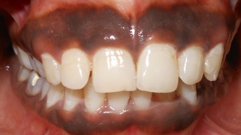 Gingival Depigmentation with Dental Lasers for Management of Gingival Hyperpigmentation