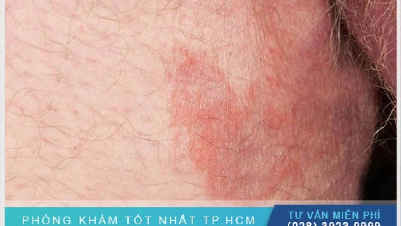 Tim hieu benh nam ben la gi