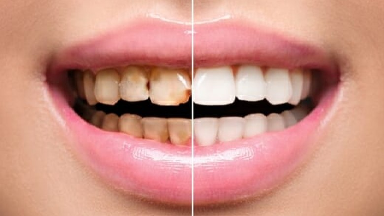 What Is the Function of Dental Veneers?